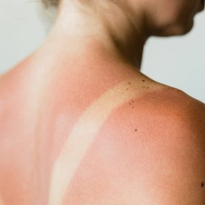 KlinekTwente - Zonnebrand