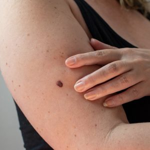 KlinekTwente - melanomen